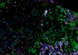 WEHI study identifies immune cells that can target small cell lung cancer